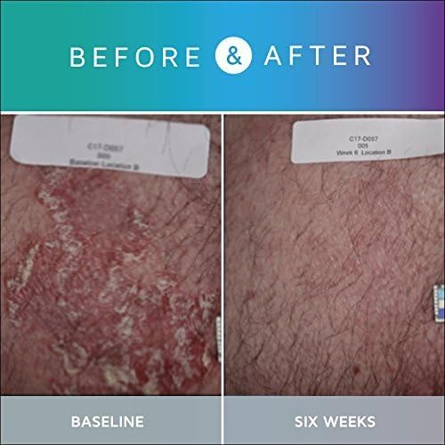 Prosoria Treatment System Single Kit – 2oz | Powerful Psoriasis Relief with Salicylic Acid, Turmeric, Shea Butter & Vitamins | Gel & Ointment for Scaling, Flaking, Dryness, Itching & Redness Relief