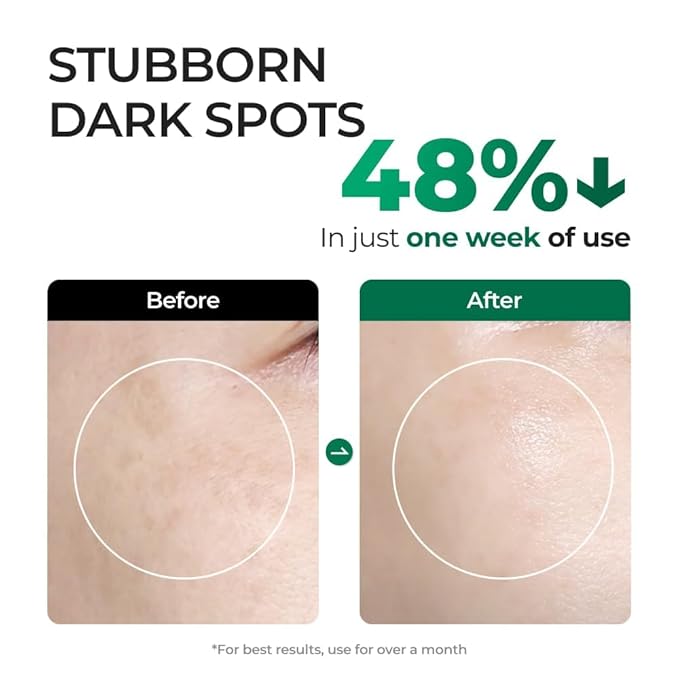 EASYDEW Dark Spot Correcting Serum for Uneven Skin Tone & Dull Skin – EGF, Niacinamide & Glutathione, Anti-Aging Formula, 0.94 Fl Oz