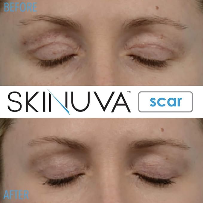 Skinuva® Next Generation Scar Cream - Advanced Silicone Scar Cream Matrix Formulated with Growth Factors & Clinically Proven to Help Reduce The Appearance of Scars (1.7 oz)