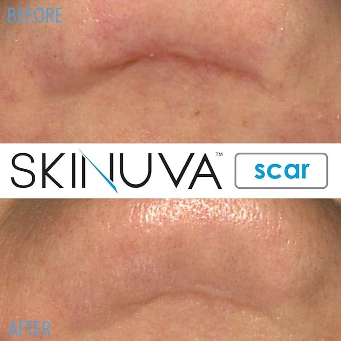 Skinuva® Next Generation Scar Cream - Advanced Scar Cream Formulated with Growth Factors (1 oz)
