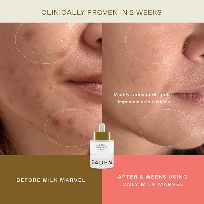 Milk Marvel Dark Spot Serum, Vitamin C Face Serum Infused with Niacinamide, Dark Spot Remover for Face and Body, Natural Dark Spot Corrector for Skin Care, 1 oz