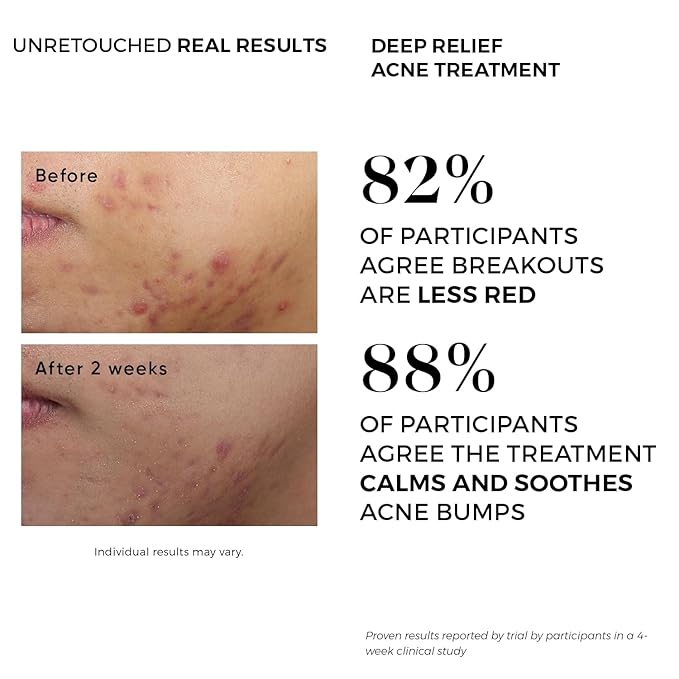 Acne Treatment Clay Mask- Clears Away Clogged Pores, Blackhead & Whitehead Pimples, Blemishes, Scars & Oily Skin for Face & Body. Ingredients Including Sulfur, Bentonite, Kaolin & Jojoba Oil.