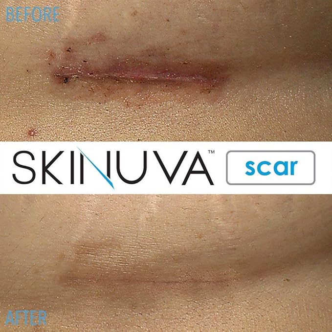Skinuva® Next Generation Scar Cream - Advanced Silicone Scar Cream Matrix Formulated with Growth Factors & Clinically Proven to Help Reduce The Appearance of Scars (1.7 oz)