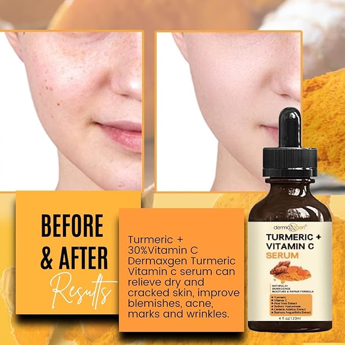 Turmeric Serum for Face + Glow-Boosting Vitamin C Serum –Organic Moisturizer for Acne, Dark Spots & Clear Skin– Boosts Hydration for Dry & Tired Skin – Anti-Aging Formula for Glowing Skin, 4 FL OZ