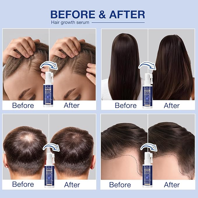 VENANOCI Hair Growth Oil Spray: with Rosemary, Biotin, Batana Oil & Rice Water – Natural Anti-Hair Loss Treatment for Thinning Hair – Promotes Thicker, Fuller Hair for Women & Men – All Hair Types