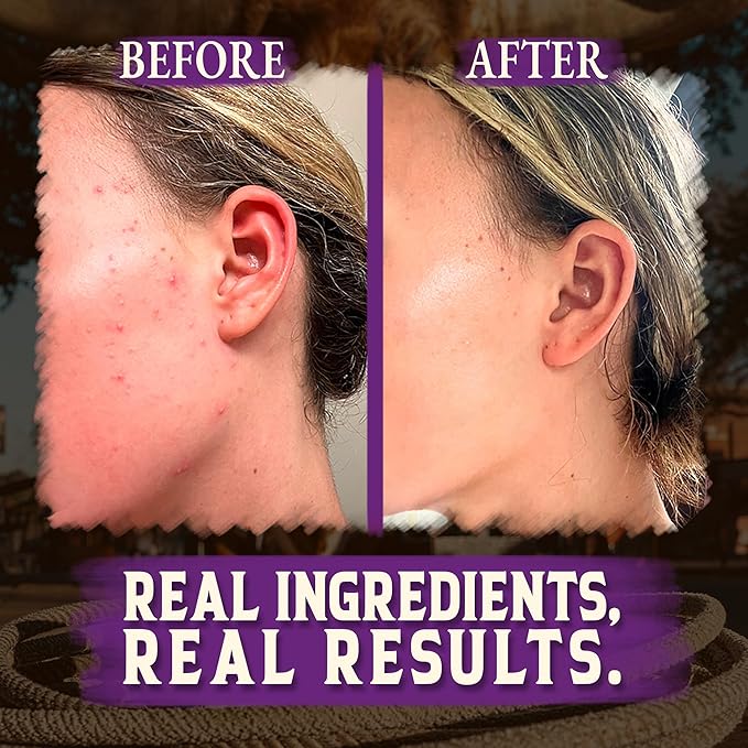 Organic Beef Tallow for Skin - 2OZ (Lavender, Concentrated) โ Grass Fed Beef Tallow for face + Body โ US-Made Tallow and Honey Balm Moisturizer for Dry & Sensitive Skin, Eczema, Rosacea(No Additives)
