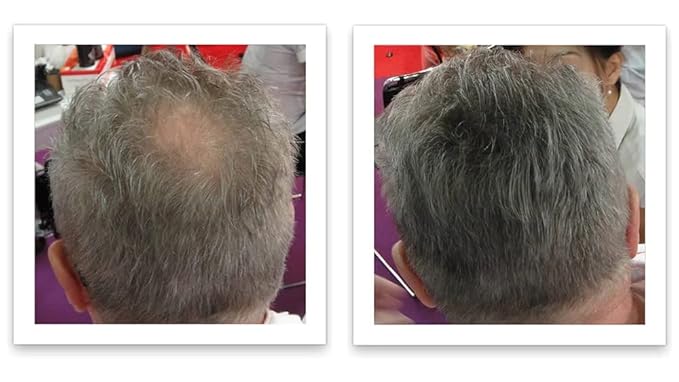 Hair Fibers For Hair Loss. Cover Bald Spot and Thinning Hair Instantly. Make Thin Hair Look 10X Fuller. All-Natural Hair Building Fiber. Trial Size (10-Day Supply). Dark Gray