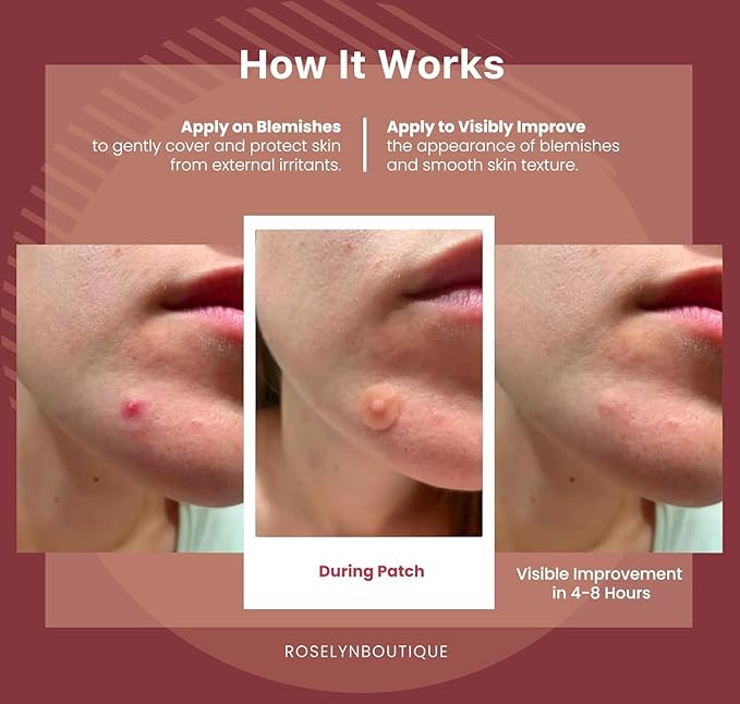ROSELYNBOUTIQUE Pimple Patches for Face - Hydrocolloid Acne Patches with Tea Tree Oil, Zits Blemishes Pore Strips - Vegan Facial Skin Care Products Cruelty-Free (150 Counts - 4 Sizes)