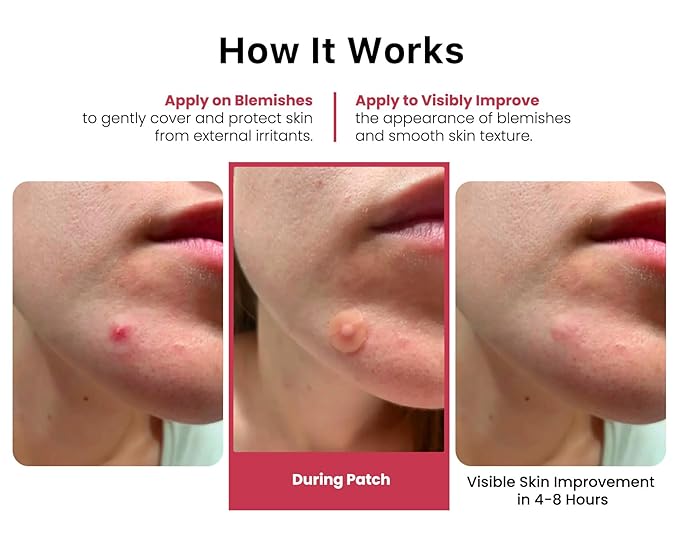 ROSELYNBOUTIQUE Pimple Patches for Face - Hydrocolloid Acne Patches For Zits Blemishes Pore Strips - Vegan Facial Skin Care Products Cruelty-Free (60 Dots)