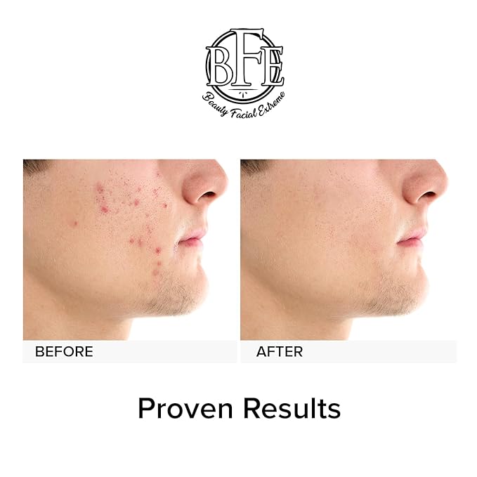 Acne Treatment Clay Mask- Clears Away Clogged Pores, Blackhead & Whitehead Pimples, Blemishes, Scars & Oily Skin for Face & Body. Ingredients Including Sulfur, Bentonite, Kaolin & Jojoba Oil.