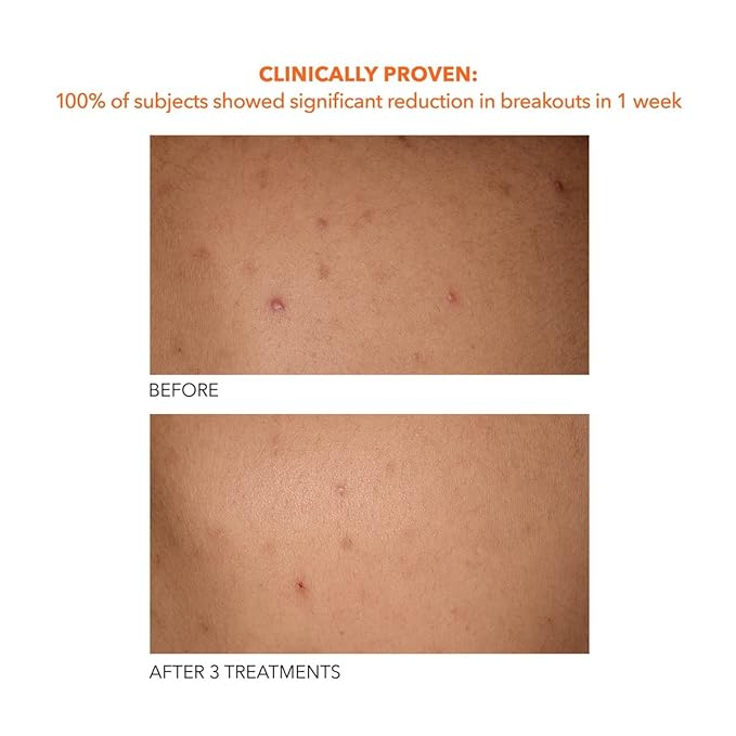 Dr. Dennis Gross Alpha Beta Exfoliating Body Treatment | Multi-Tasking Powered by AHA/BHAs for Smooth, Hydrated Skin While Improving Ingrown Hairs, Keratosis Pilaris, and Blemishes | 2 Textured Towels