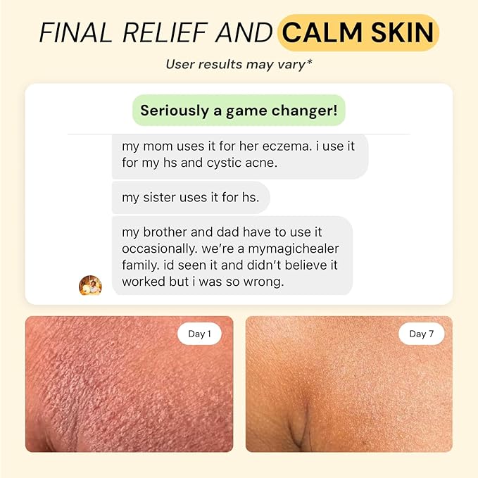 MyMagicHealer Universal Flare Care | Essential Oil Free | Relief for Rashes, Eczema, Psoriasis, Hidradenitis Suppurativa, Impetigo, Dermatitis, Wound Care, Sensitive Skin w/Propolis & Egg Yolk 4 oz