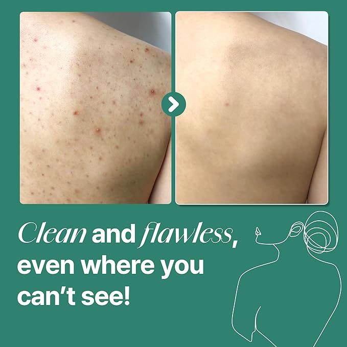 SOME BY MI AHA BHA PHA 30 Days Miracle Acne Clear Body Cleanser - Pack of 2 - Daily Exfoliating Tea Tree Acne Body Wash with Salicylic Acid - Deep Cleanses Sebum and Impurities - Korean Skin Care