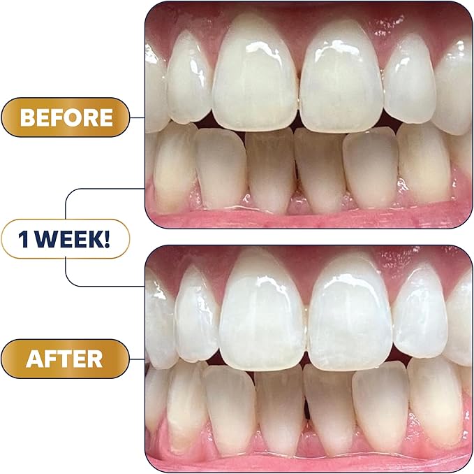 Lumineux Longevity Whitening Kit Bundle - Contains 6X Toothpastes, 6X Mouthwashes, 2X Strips and 2X Whitening Pens - Enamel Safe and Clinically Proven to Whiten Without The Sensitivity