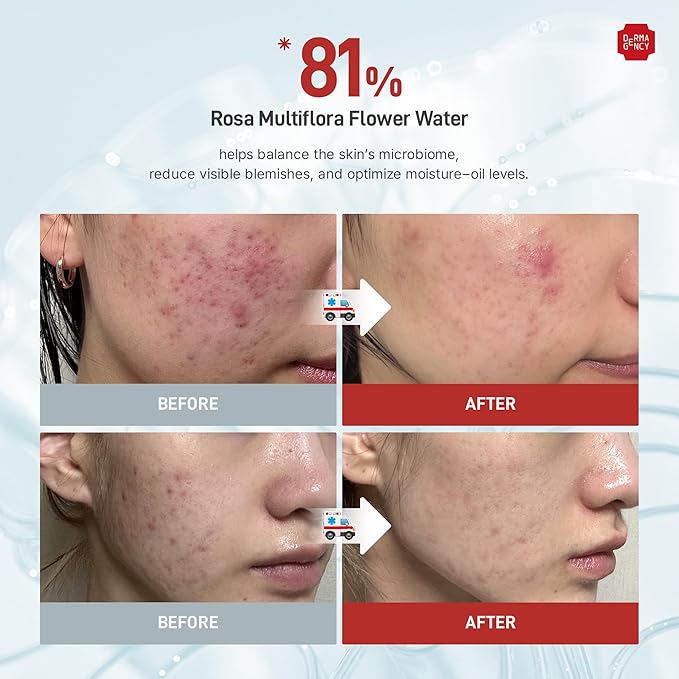 Zeroca 81 Korean Calming Cream for Acne-Prone & Sensitive Skin – Lightweight and gentle daily soothing moisturizer, Controls Sebum, Deeply Hydrates & Smooths Texture (2.02 fl.oz. 60 ml)