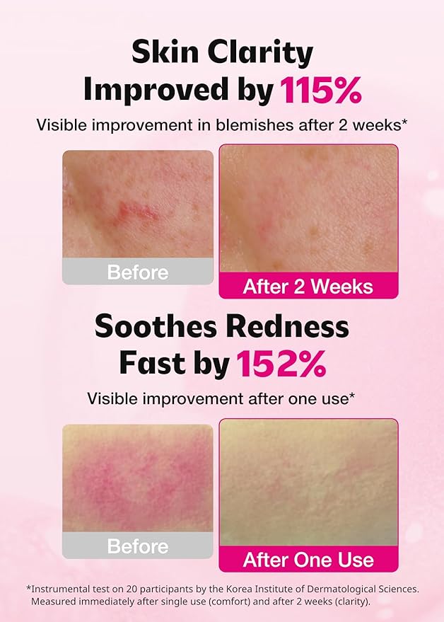 ISOI Blemish Care Up Serum for Face, Vegan Hydrating Serum for Smooth & Glass Skin Effect, Skin Barrier & Moisture Balance for Women, Arbutin, Korean Skin Care (0.85 fl. oz, 25ml)