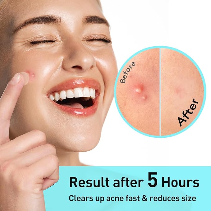 TKTK Pimple Patches, 12mm Invisible Acne Patches for Face with Salicylic Acid, 0.01cm Extra Thin Outer Edge, Hydrocolloid Zit Patch for Pustule, Whitehead, Cystic Acne Spot, 96 Count