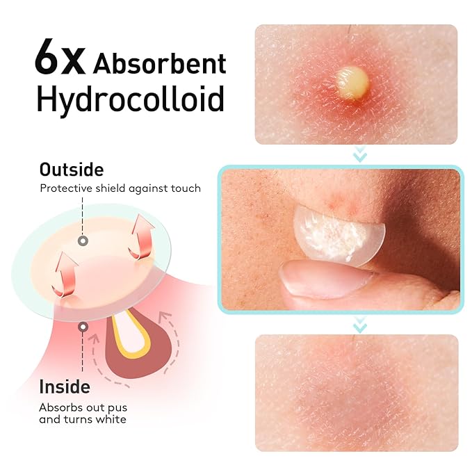 TKTK Pimple Patches, 12mm Invisible Acne Patches for Face with Salicylic Acid, 0.01cm Extra Thin Outer Edge, Hydrocolloid Zit Patch for Pustule, Whitehead, Cystic Acne Spot, 96 Count