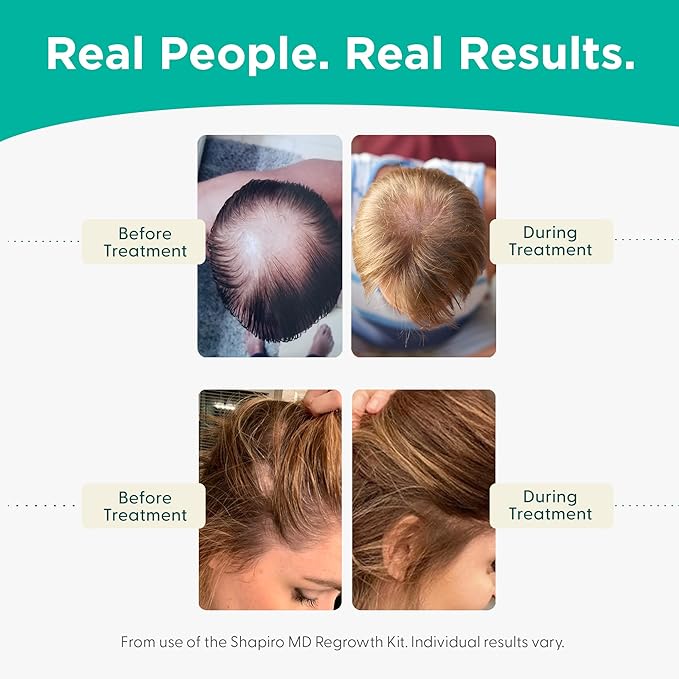 Shapiro MD Hair Growth Experts Hair Loss Shampoo and Conditioner, DHT Fighting Vegan Formula for Thinning Hair Developed by Dermatologists, Experience Healthier & Thicker Hair - 2 Month Supply