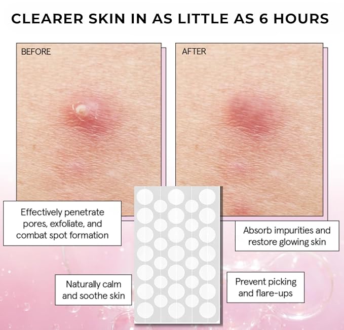 Pimple Patches- Advanced Acne Treatment For Zits and Blemishes. Hydrocolloid Spot Treatment with Salicylic Acid & Tea Tree Oil- Pimple Patch for Face- 72 ct