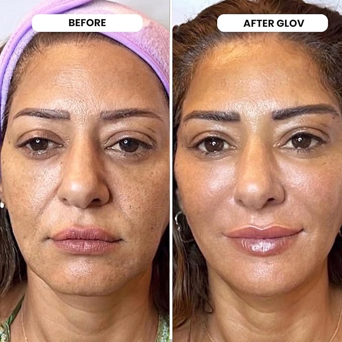 Glov Beauty Micro Infusion System for Face & Lips – 0.25mm 24k Gold Cosmetic Facial Stamp with Hyaluronic Acid, Collagen Peptides & Licorice Root Serum Ampoules | At-Home Hydrating & Plumping Glow Kit