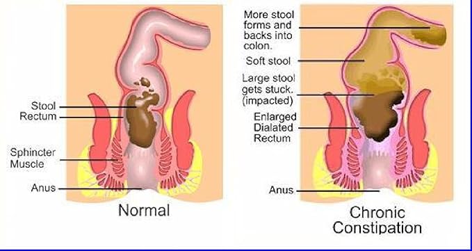 The One Minute Miracle - Miracle Oxy-Colon Cleanse - Colon Cleanser for 2 Day Cleanser