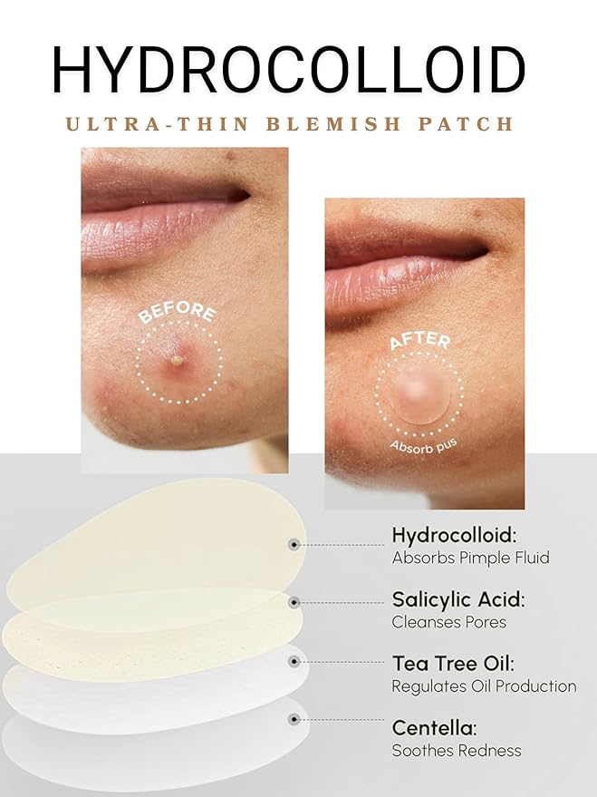 Clear Pimple Patches- Hydrocolloid Fast Acting Pimple Patch w/ Salicylic Acid & Tea Tree Oil Fights Breakouts & Blemishes. Acne Spot Treatment for Face- 108 Ct.