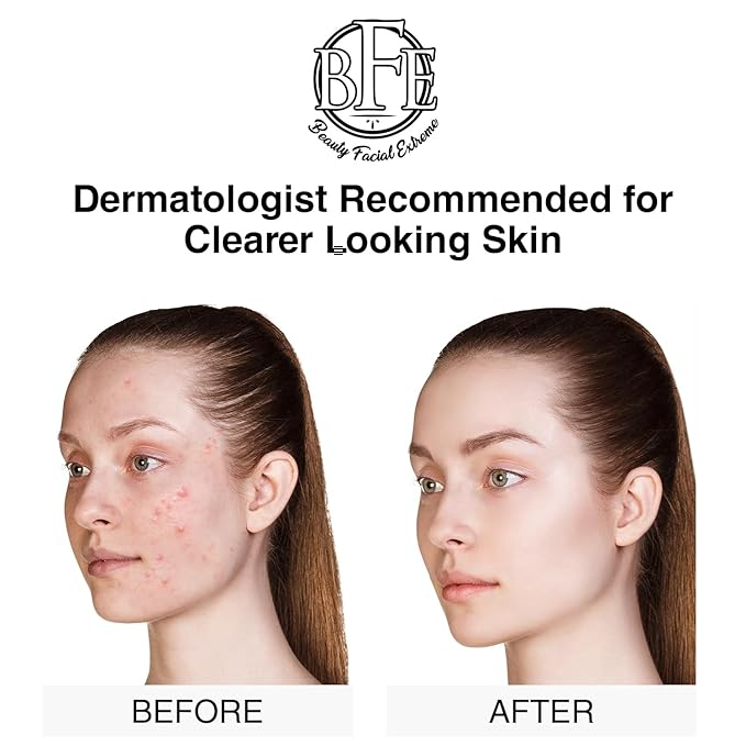 Acne Treatment Clay Mask- Clears Away Clogged Pores, Blackhead & Whitehead Pimples, Blemishes, Scars & Oily Skin for Face & Body. Ingredients Including Sulfur, Bentonite, Kaolin & Jojoba Oil.