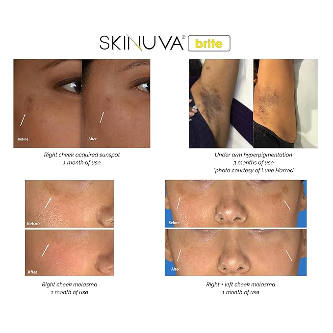 Skinuva® Brite Dark Spot Treatment – Tone-Enhancing Cream Formulated with Growth Factors, Vitamin C, and Niacinamide For All Skin Types (30ml - 2 pack)