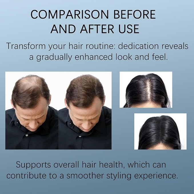 Hair Growth Essence Roll-On Bottle – 3% Rosemary, 3% Redensyl, and 2% Anagain – Lightweight, non-greasy scalp essence, free of preservatives and sulfates – Suitable for both men and women (1)