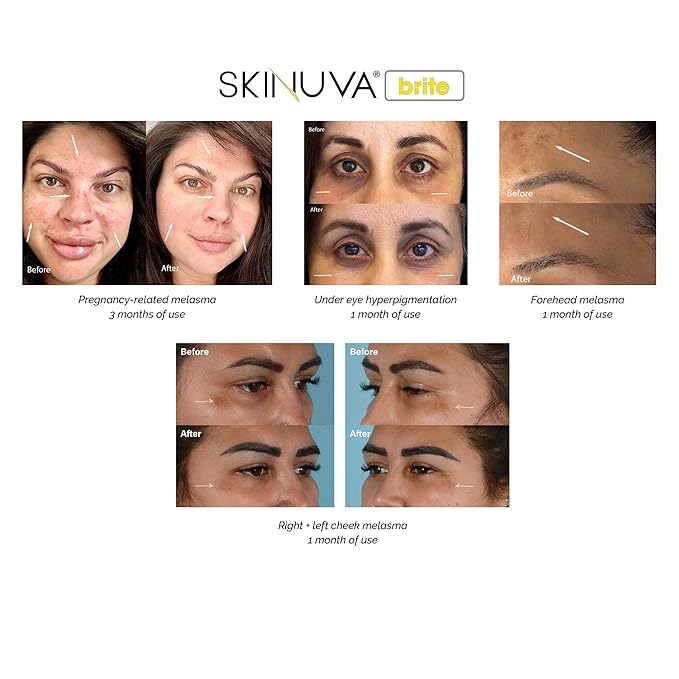 Skinuva® Brite Dark Spot Treatment – Tone-Enhancing Cream Formulated with Growth Factors, Vitamin C, and Niacinamide For All Skin Types (30ml - 2 pack)