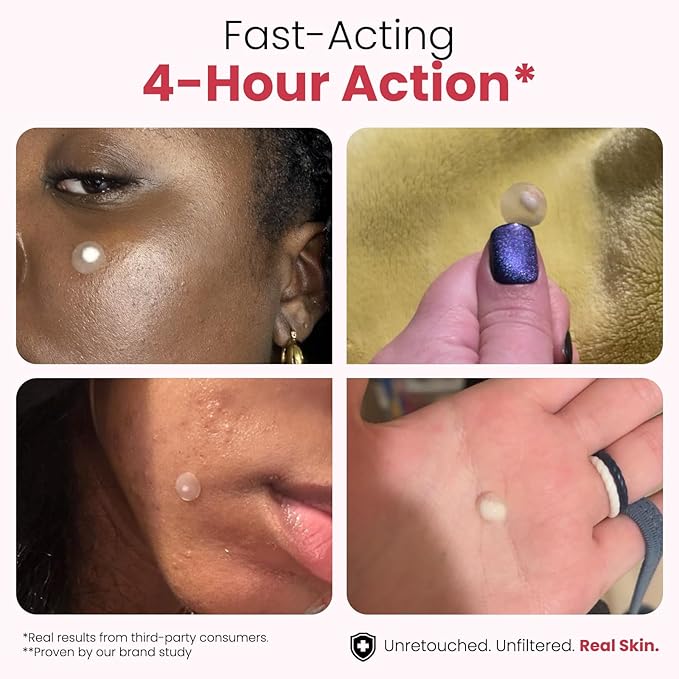 ROSELYNBOUTIQUE Pimple Patches for Face 300 Counts 4 Sizes Hydrocolloid Acne Patches with Tea Tree Oil,Salicylic/A, Zits Blemishes Pore Strips - Vegan Facial Skin Care Products Cruelty-Free