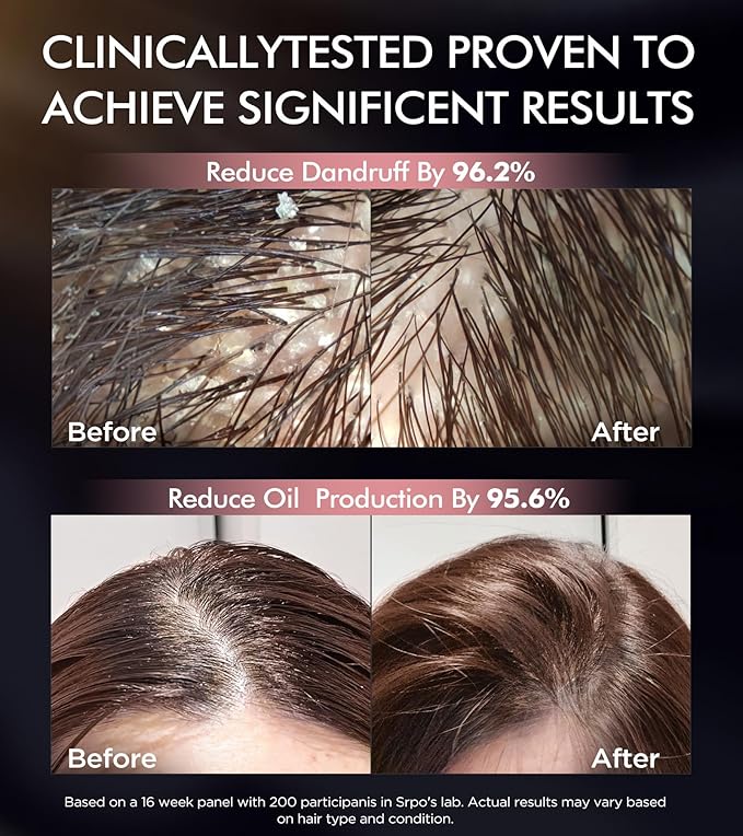 Hair Growth Biotin Shampoo and Conditioner Set, Onion Anti-Loss Volumizing Moisturizing Treatment for Soft Shine Hair, Rosemary Clarifying Dandruff Shampoo for Women Men, 2 x 16.9oz