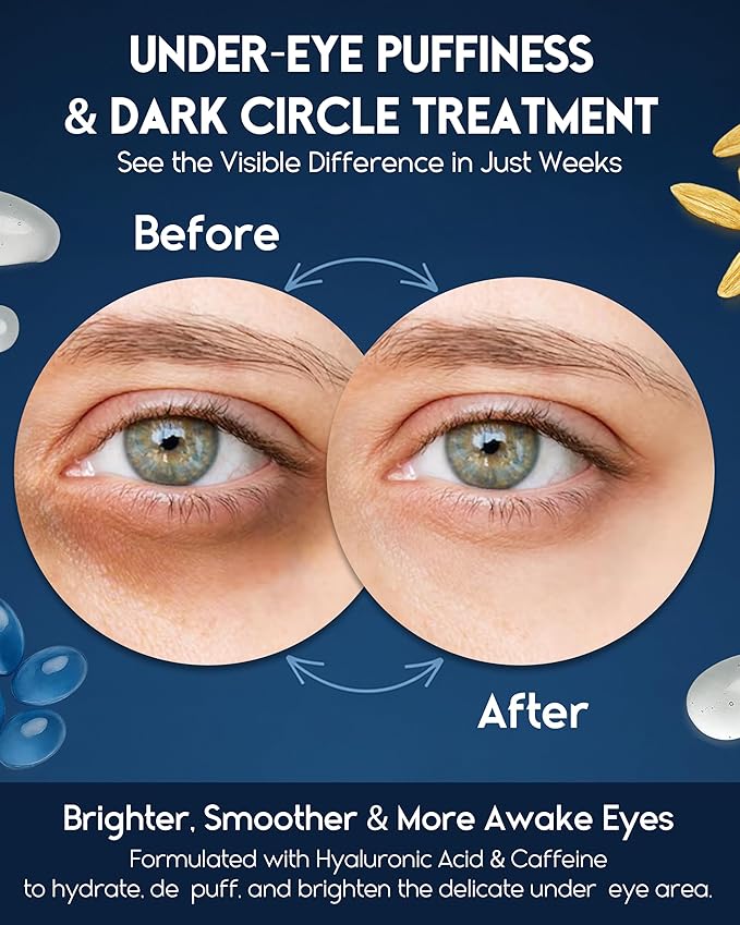 Under Eye Cream for Puffiness and Bags Under Eyes, Eye Bags Treatment for Men & Women - Anti Wrinkle Cream for Dark Circles, Baggy Eyes Treatment for Women with Retinol, Hyaluronic Acid & Caffeine