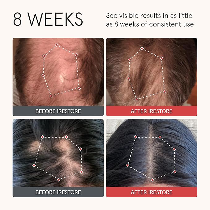 iRestore Anti Hair Loss and Thinning Shampoo - Biotin Formula for Hair Growth, Thickening and Volumizing for Men & Women