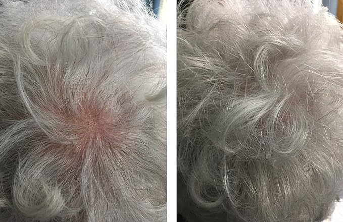 Hair Thickening Fibers. Cover Bald Spot and Thinning Hair Instantly. Make Thin Hair Look 10X Fuller. All-Natural Hair Building Fiber. Trial Size (10-Day Supply). Silver/White