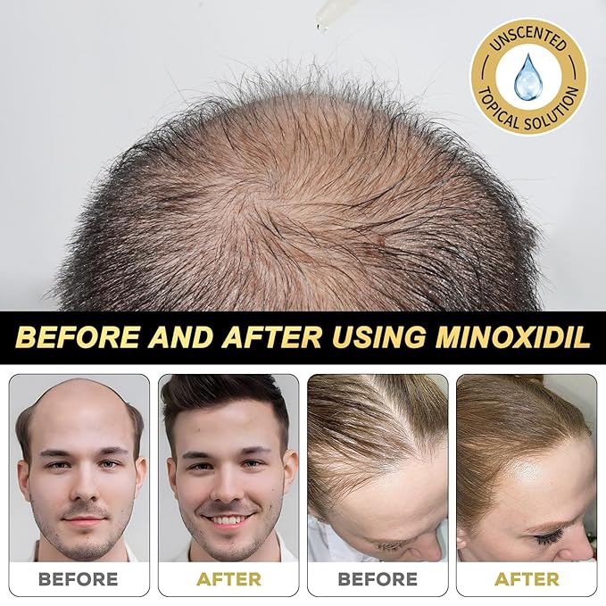 5% Minoxidil for Men and Women Hair Growth Serum, Biotin Hair Growth, Hair Regrowth Treatment for Scalp Hair Loss Hair Thinning for Thicker Longer Fuller Healthier Hair (Pack of 1)