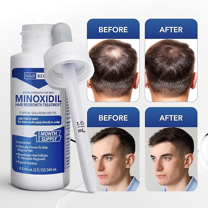 Advanced 5% Minoxidil Topical Solution For Men Hair Growth Serum Treatment for Thinning Hair - Hair Loss for Men - 1 Month Supply, Minoxidil Drop So Thicker Fuller Hair Keeps Growing Amazing Results