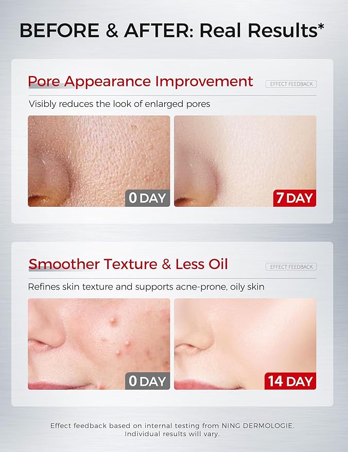 2% Salicylic Acid Serum: Pore Minimizer & Acne Treatment for Face with AHA PHA Tranexamic Acid Niacinamide & Tembusu Extract | Exfoliant for Acne & Blemish Skin | Oil Control | 1 FL OZ