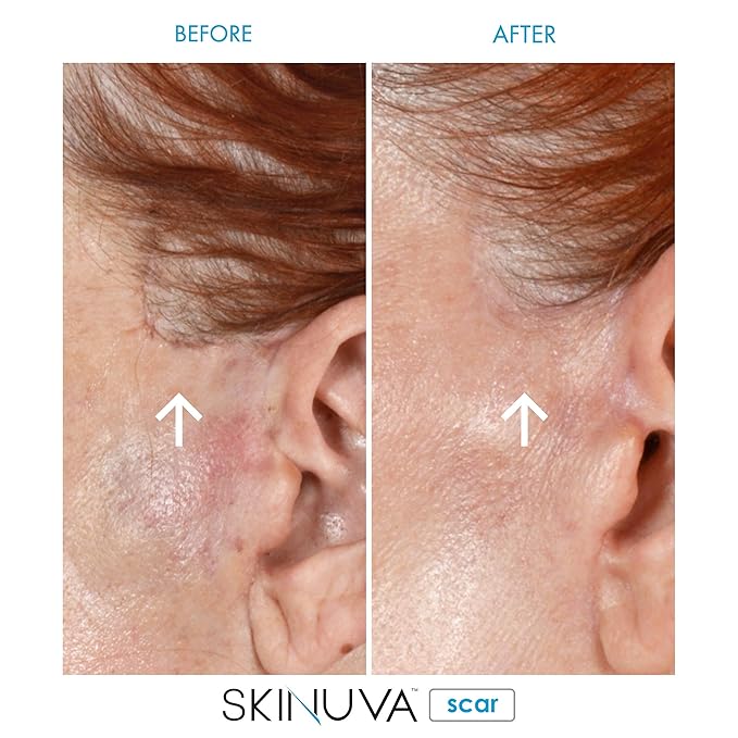 Skinuva® Next Generation Scar Cream - Advanced Silicone Scar Cream Matrix Formulated with Growth Factors & Clinically Proven to Help Reduce The Appearance of Scars (1.7 oz)