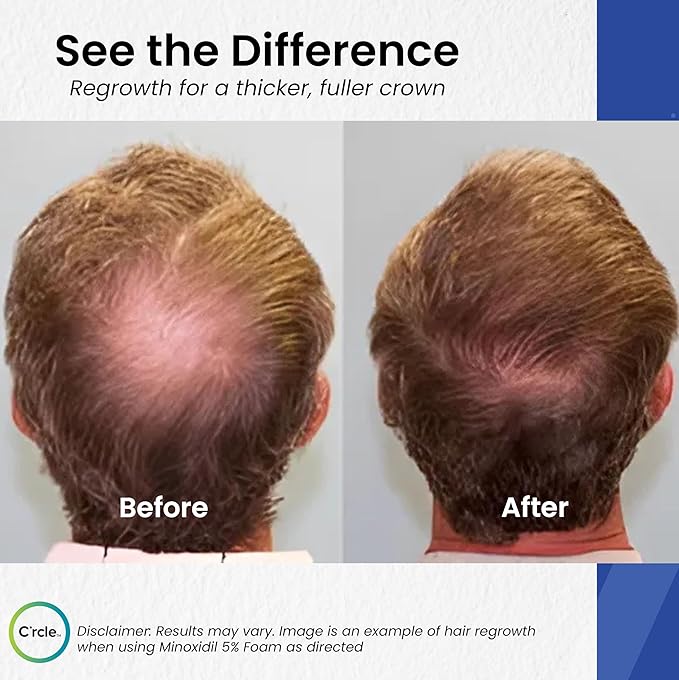 C’rcle Men's Minoxidil 5% Foam - Unscented 6 Month Supply - Helps Restore Vertex Hair Loss & Thinning - Extra Strength Supports Hair Regrowth for Men