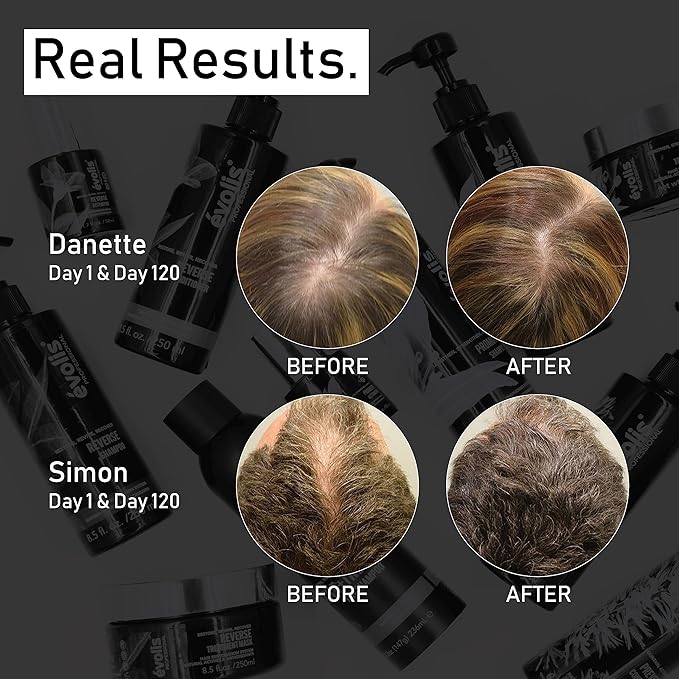 EVOLIS Prevent Anti-Aging Activator Scalp Treatment – Advanced Scalp Serum for Follicle Health – Dry Scalp Treatment with Rosemary Oil (1.7 fl oz)