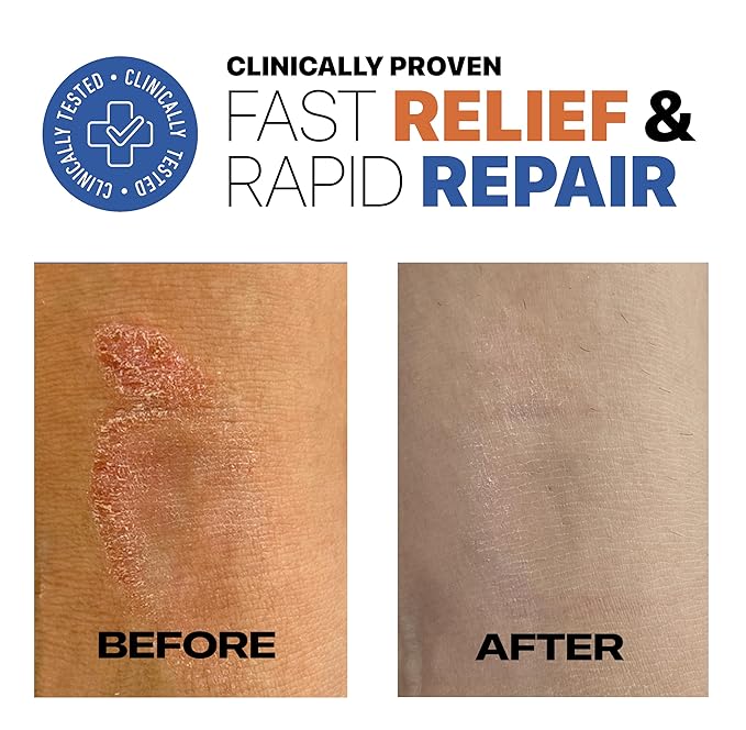 Eczema Relief & Repair Moisturizer for Face & Body. Hydrating & Nourishing Eczema Cream for Very Dry, Sensitive, Itchy Skin. National Eczema Association Accepted. Vegan, Made in USA, 94g